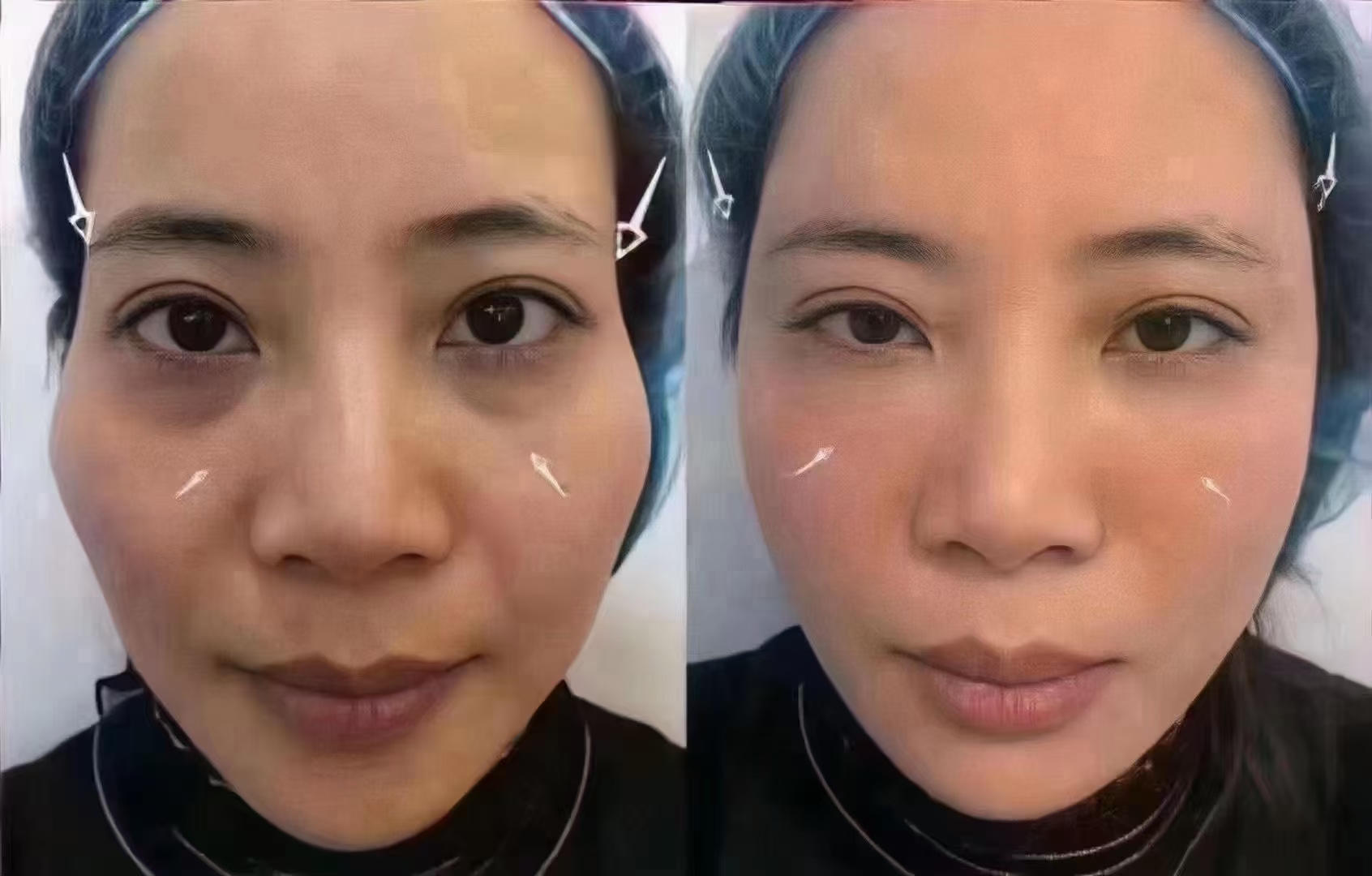 菲诗奇迹太阳穴填充效果对比