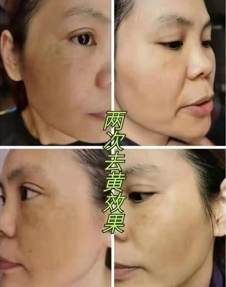 菲诗奇迹美白淡斑两次效果