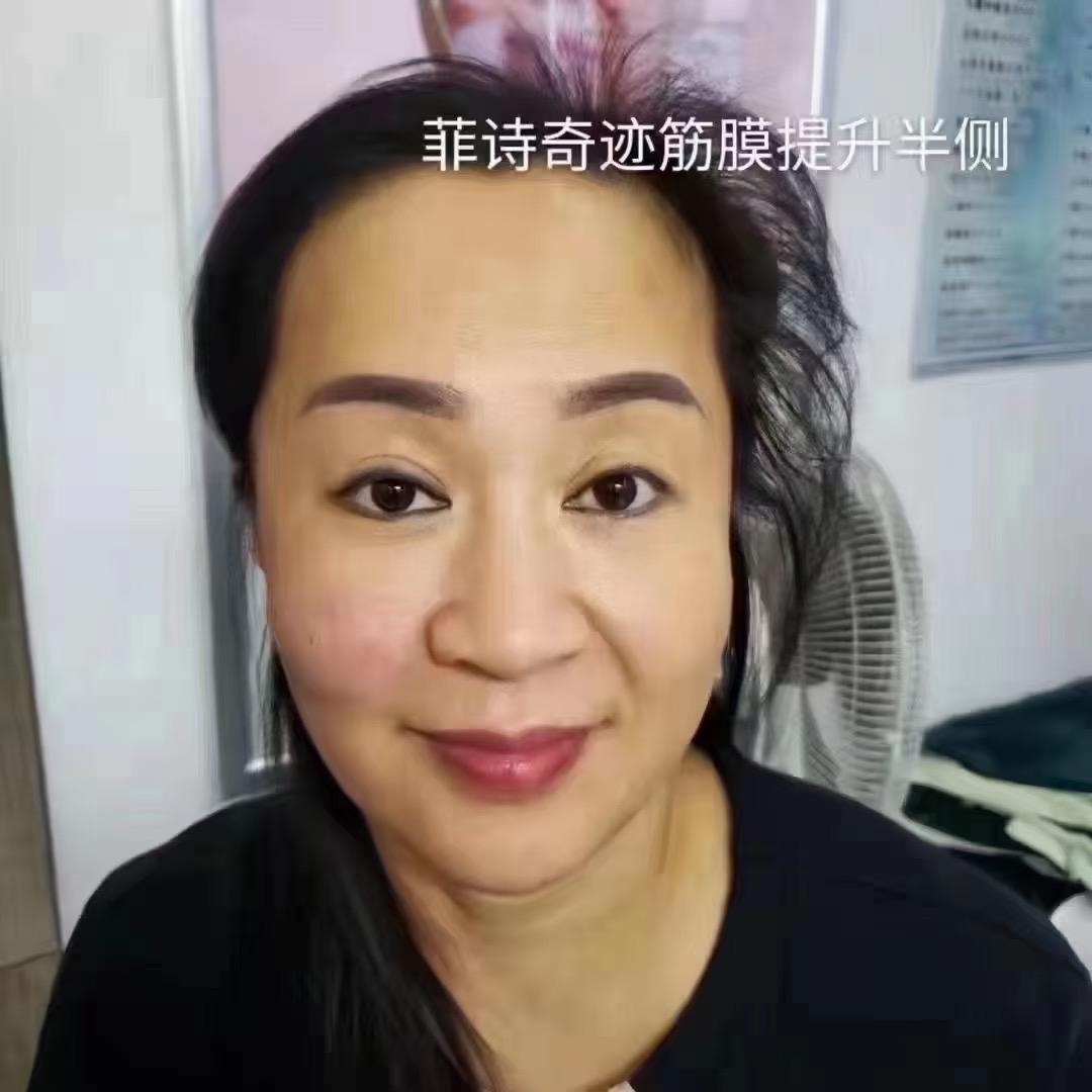 菲诗奇迹筋膜提升效果对比