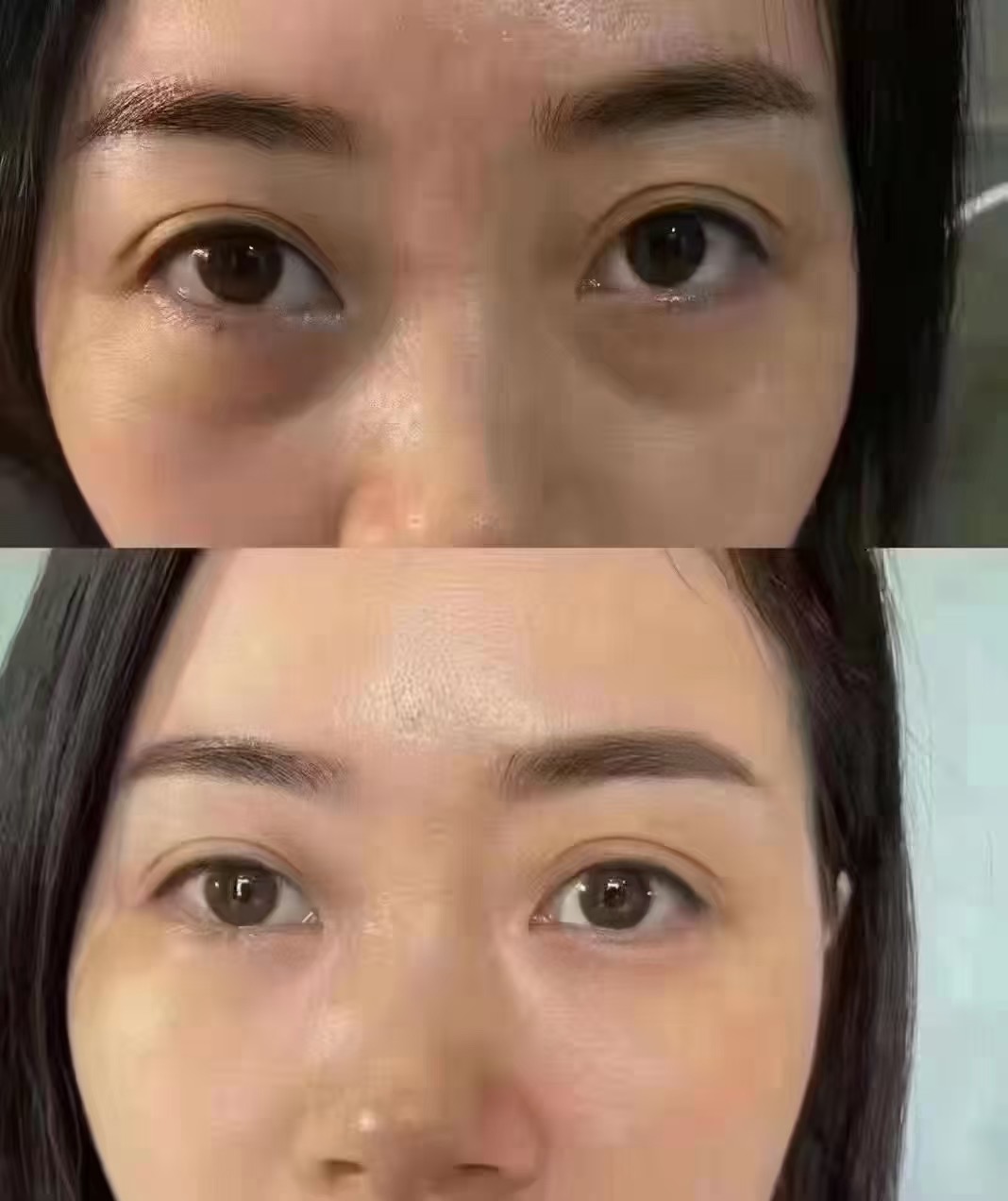 菲诗奇迹眼袋泪沟效果对比