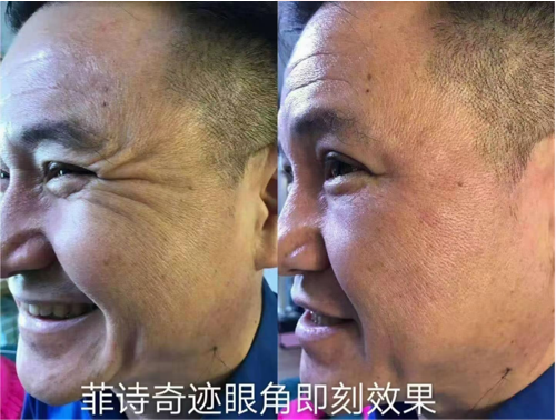 菲诗奇迹去眼角纹效果对比