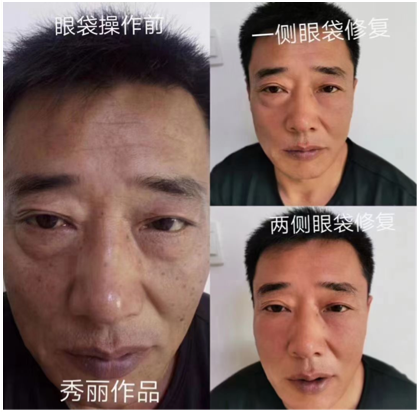 菲诗奇迹去男士眼袋效果对比