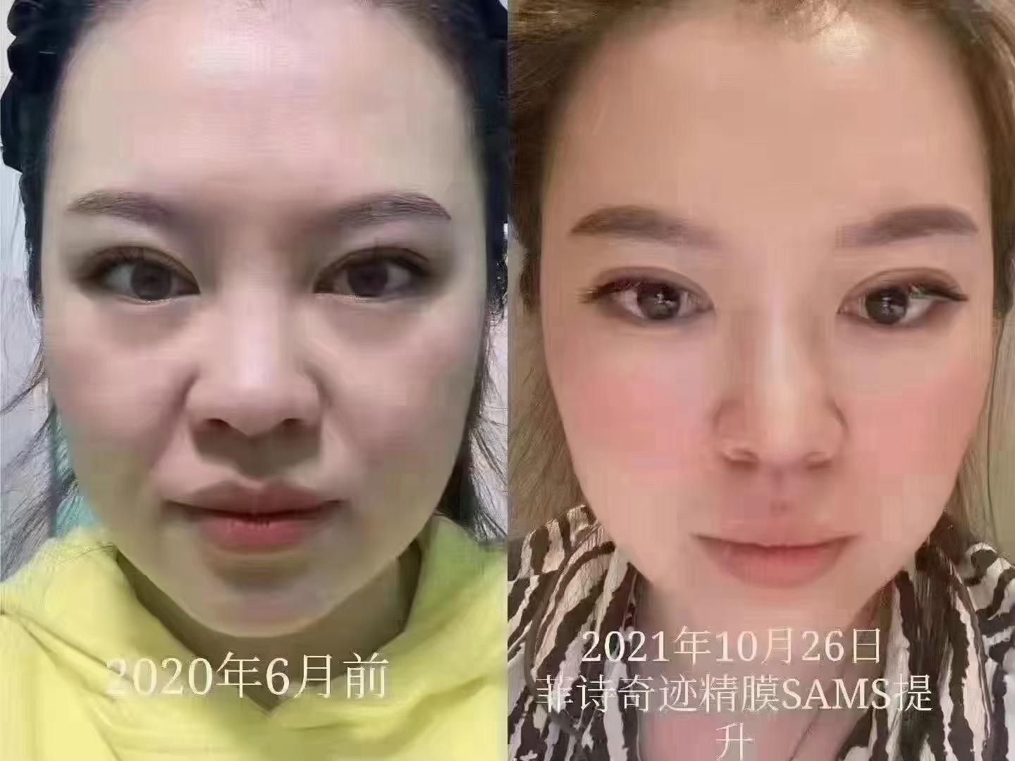 菲诗奇迹筋膜提升效果对比