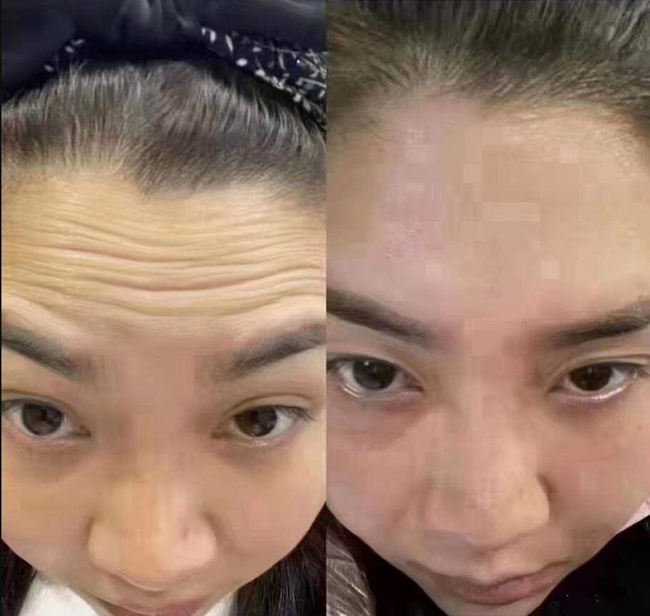 菲诗奇迹去抬头纹效果对比